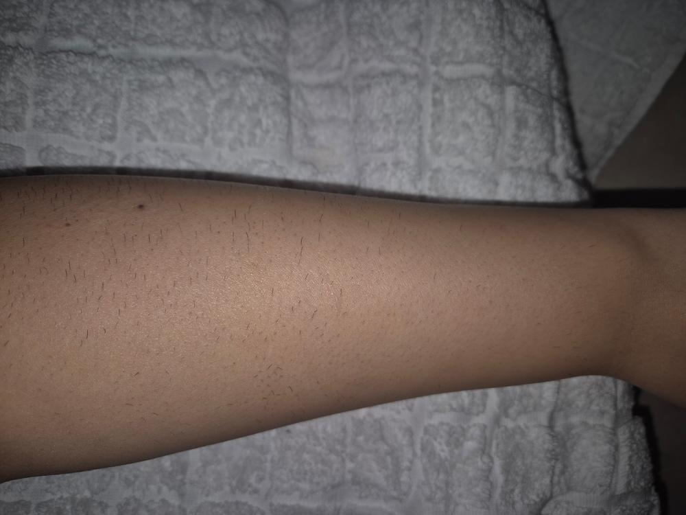 Lumi - Permanent Hair Removal Device - Customer Photo From Michelle ben boaz