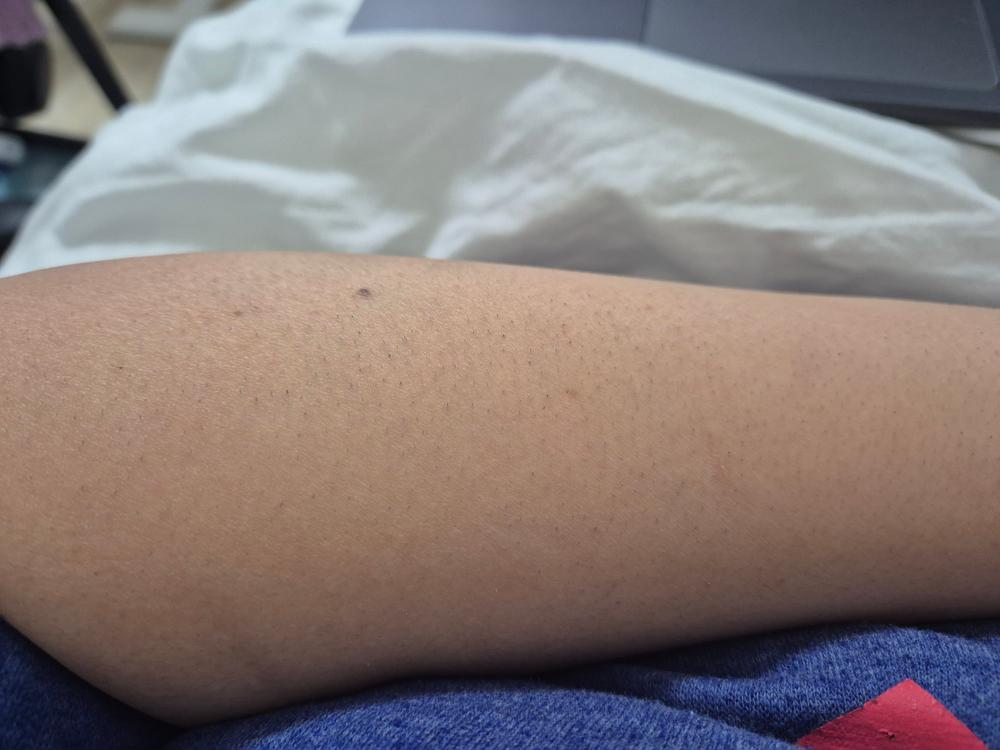 Lumi - Permanent Hair Removal Device - Customer Photo From Michelle ben boaz