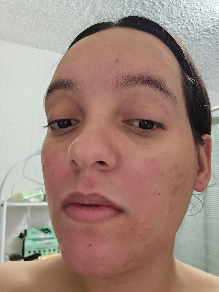 Acne Foaming Cleanser - Customer Photo From Adriana 
