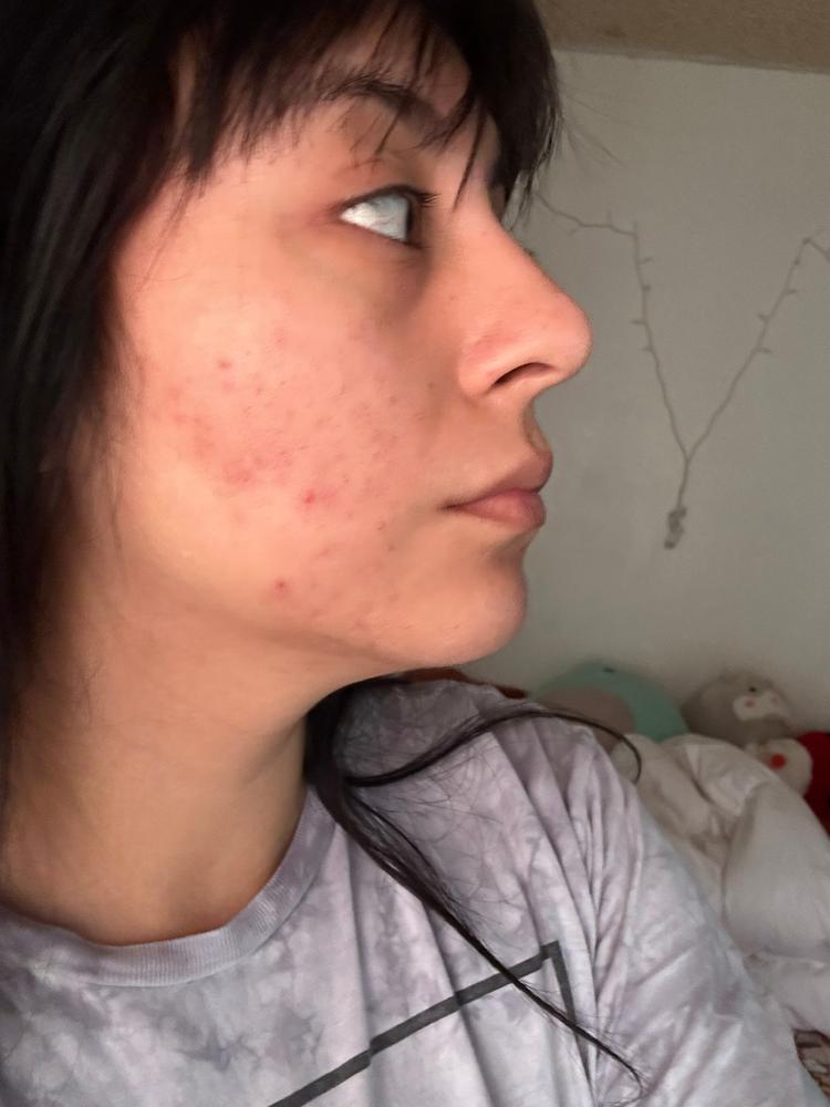 Acne Foaming Cleanser - Customer Photo From Nicole