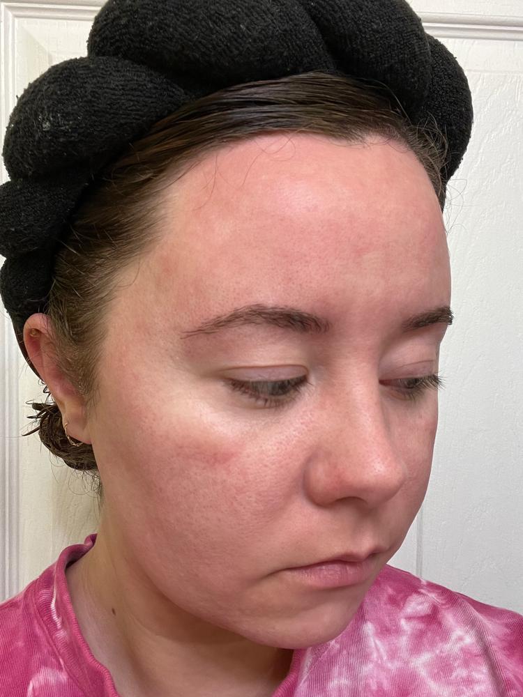Acne Foaming Cleanser - Customer Photo From Courtney