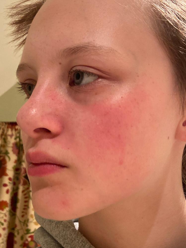 Acne Foaming Cleanser - Customer Photo From Sophia