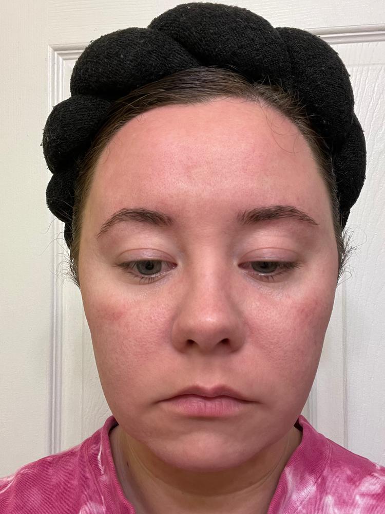 Acne Foaming Cleanser - Customer Photo From Courtney