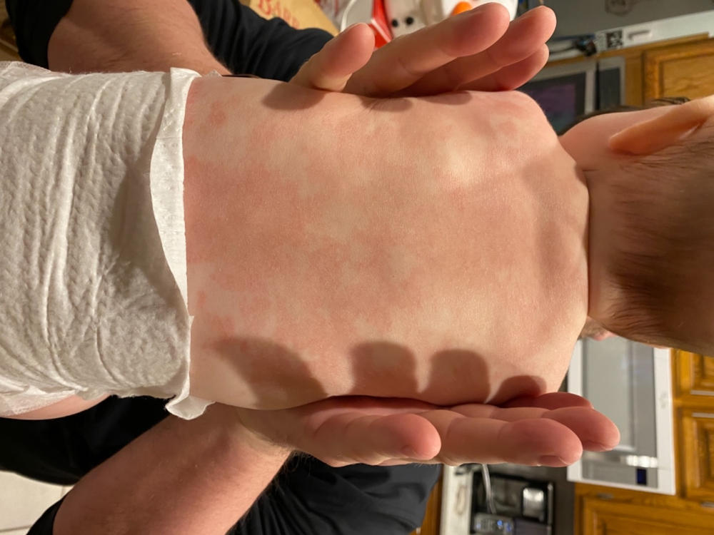 EWG Verified and NEA Accepted Baby Eczema Lotion Pipette