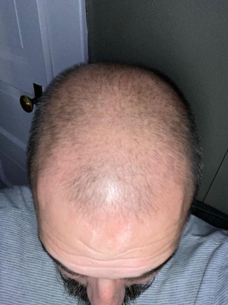 Particle Hair Vitamin Gummies - Customer Photo From Alex Pacheco