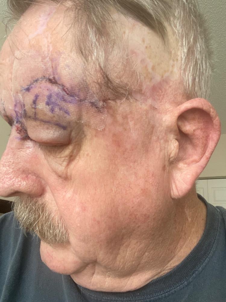 Particle Scar Gel - Customer Photo From Timothy Murphy