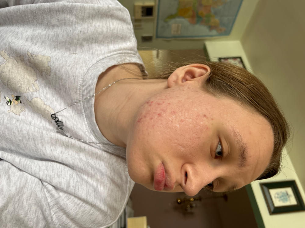 TrueClear™ Acne Clarifying Supplement - Customer Photo From Ruth Gerwin