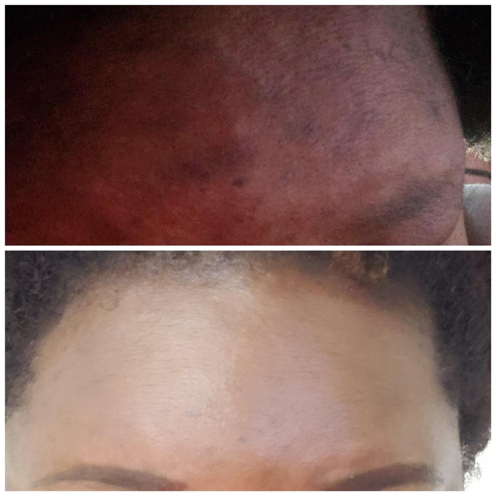 18% TCA At Home Peel - Customer Photo From Kimoy W.