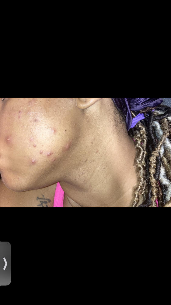 30% Glycolic Acid At Home Peel - Customer Photo From Rosalieah