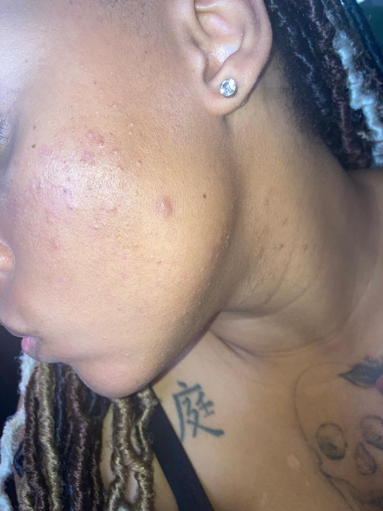 30% Glycolic Acid At Home Peel - Customer Photo From Rosalieah