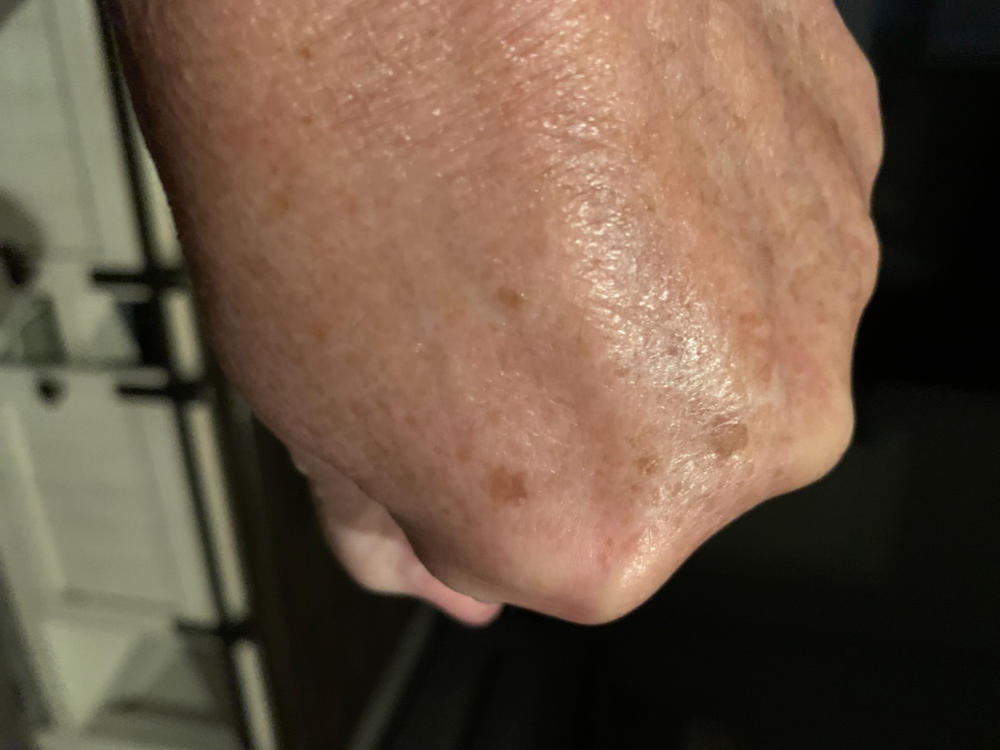 Gly-Luronic Serum - Glycolic Hyaluronic - Customer Photo From Mary Beth Ono