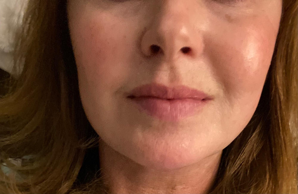 40% Mandelic Acid At Home Peel - Customer Photo From Melodie M.