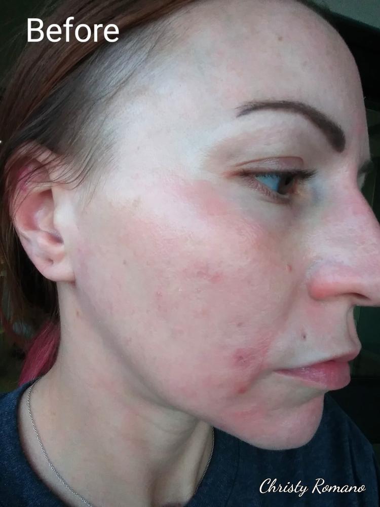 40% Mandelic Acid At Home Peel - Customer Photo From Christy Ann Romano