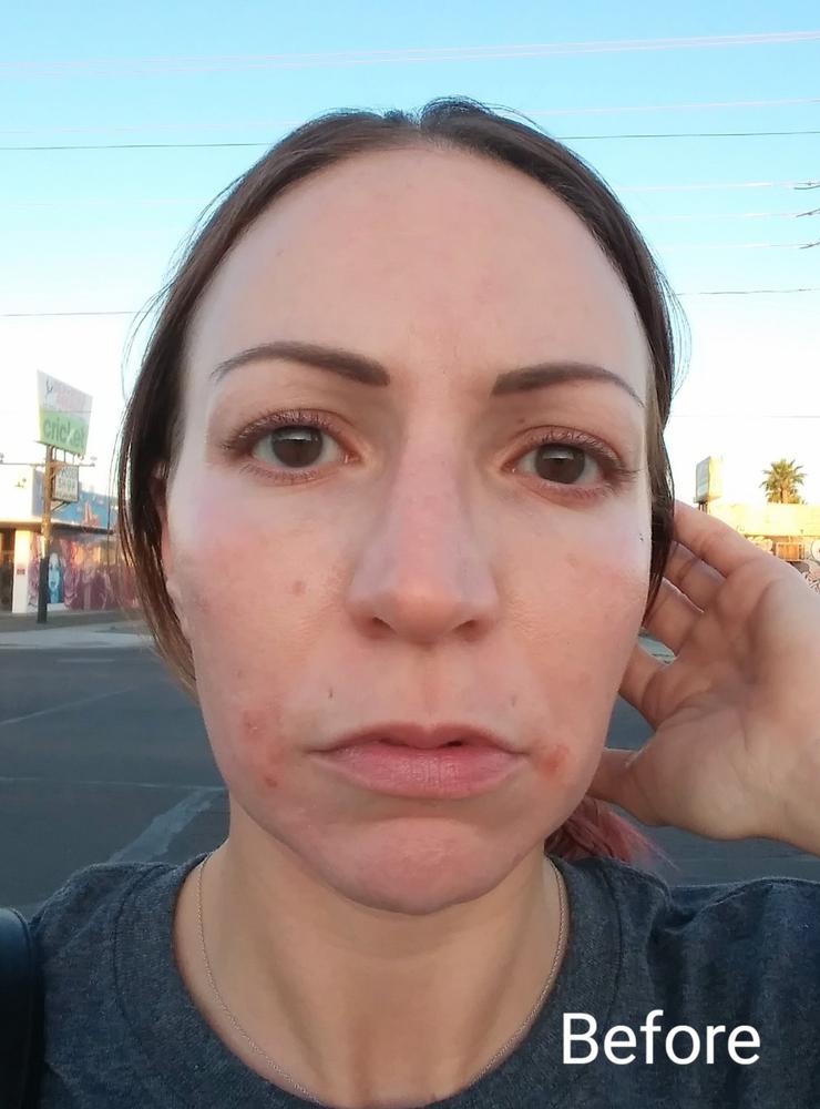 40% Mandelic Acid At Home Peel - Customer Photo From Christy Ann Romano