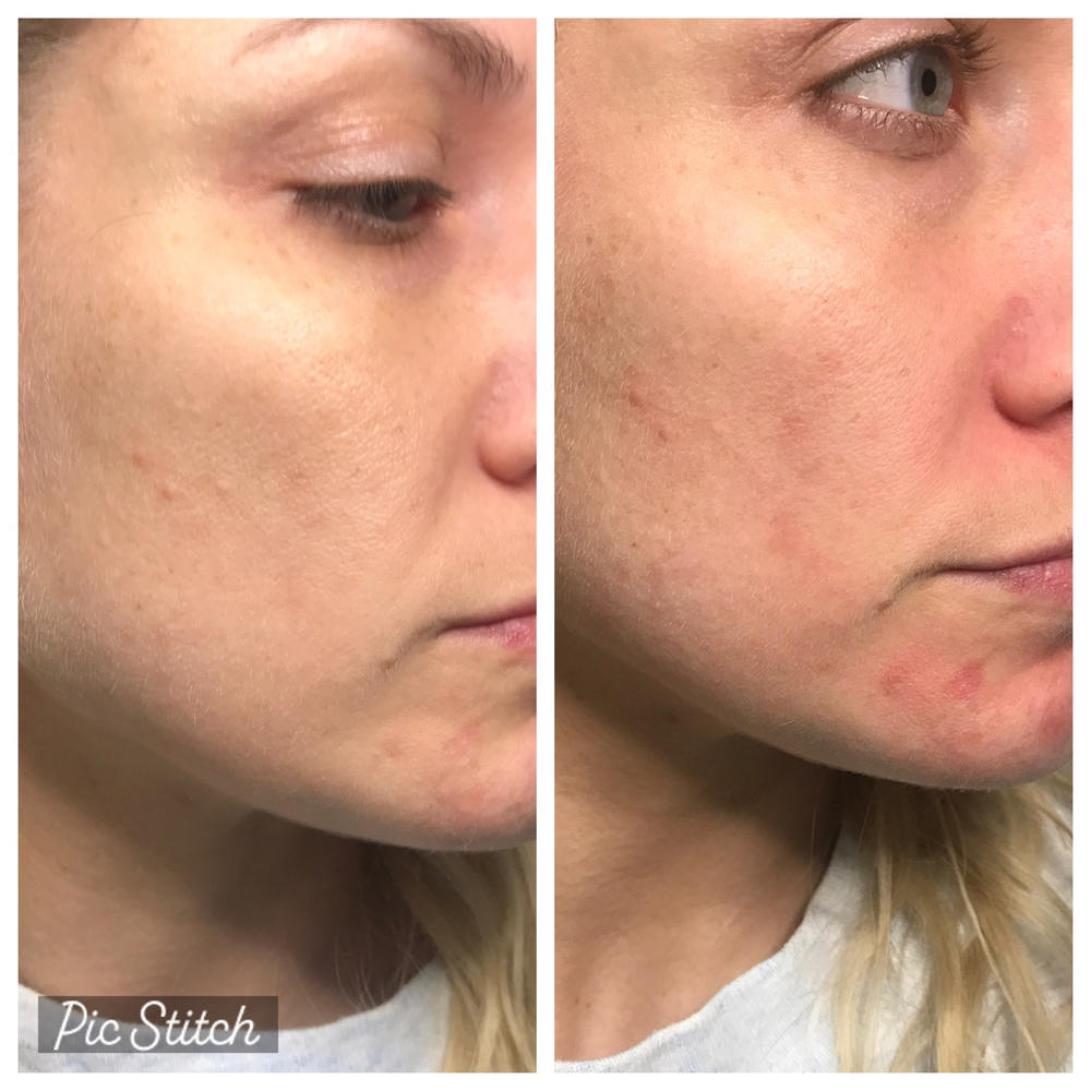 Nano-Hyaluronic - Advanced Hyaluronic Acid Serum w/Watermelon Extract - Customer Photo From Ashley B.