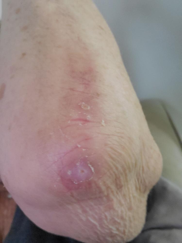40% Lactic Acid Peel - Customer Photo From Michelle Kucic